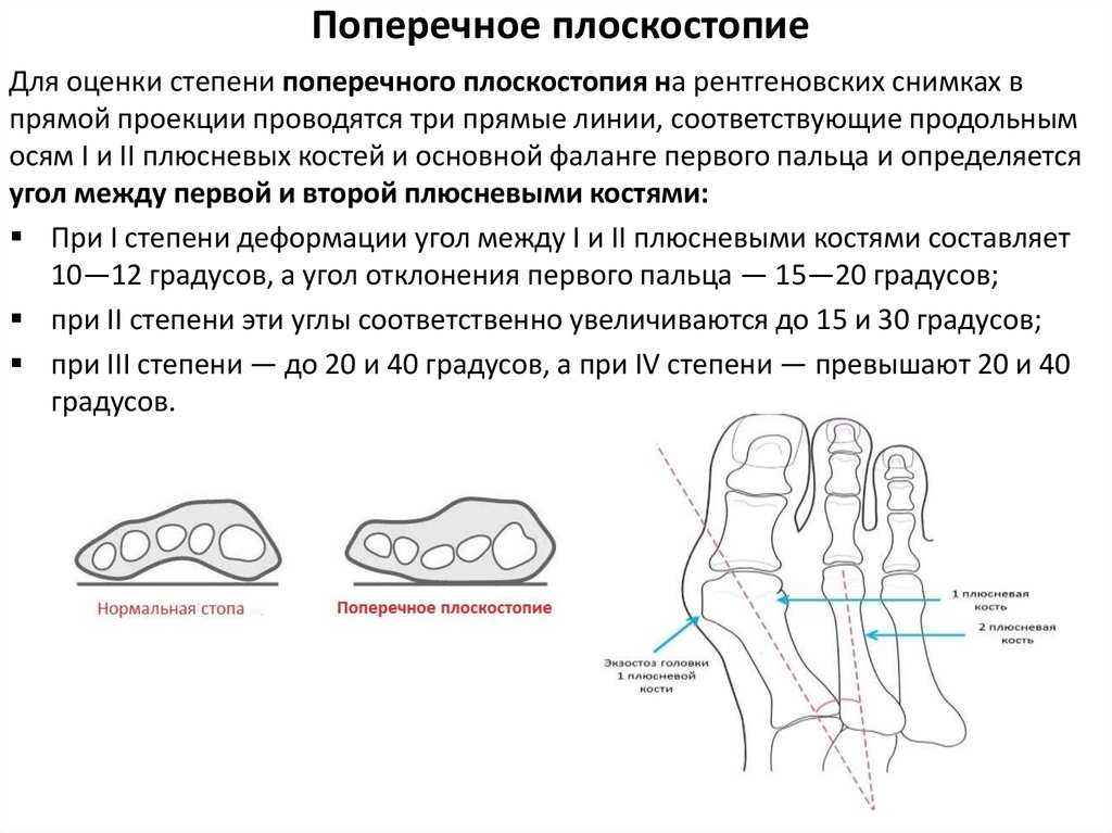 Закрытый перелом костей плюсны карта вызова