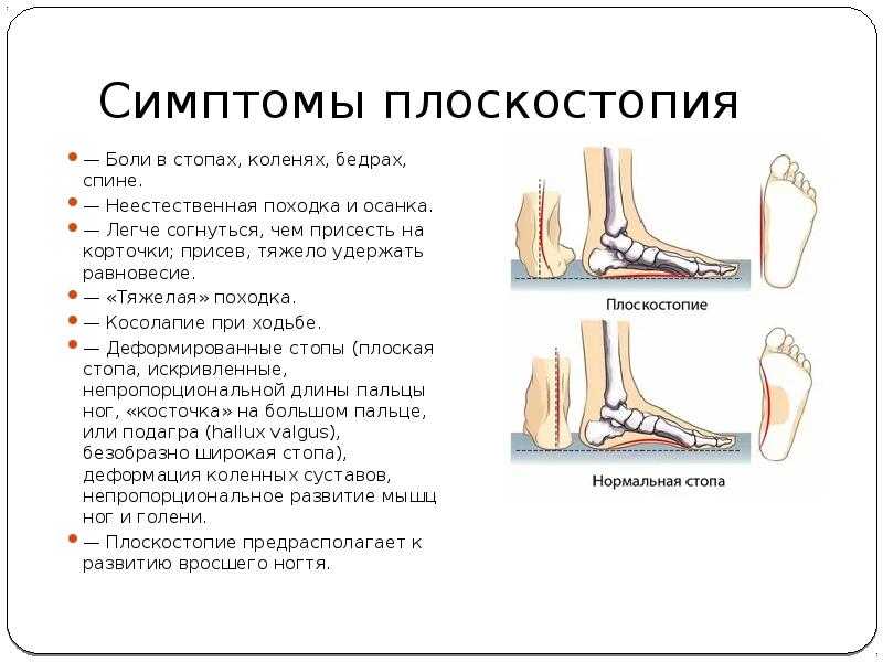 Ноют ноги в покое причины. Причины плоскостопия. Плоскостопие сбоку. Свод стопы при плоскостопии. Причины и симптомы плоскостопия.