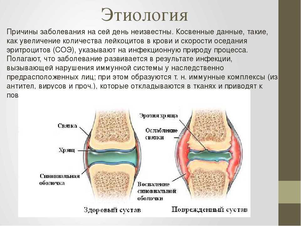 Гнойные заболевания суставов. Ревматоидный артрит суставов патогенез. Артрит описание болезни. Ревматоидный артрит презентация.