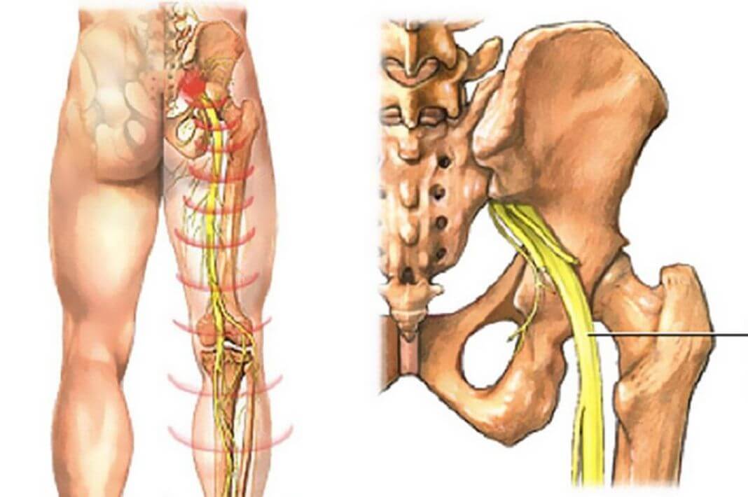 Защемление седалищного нерва симптомы и лечение фото