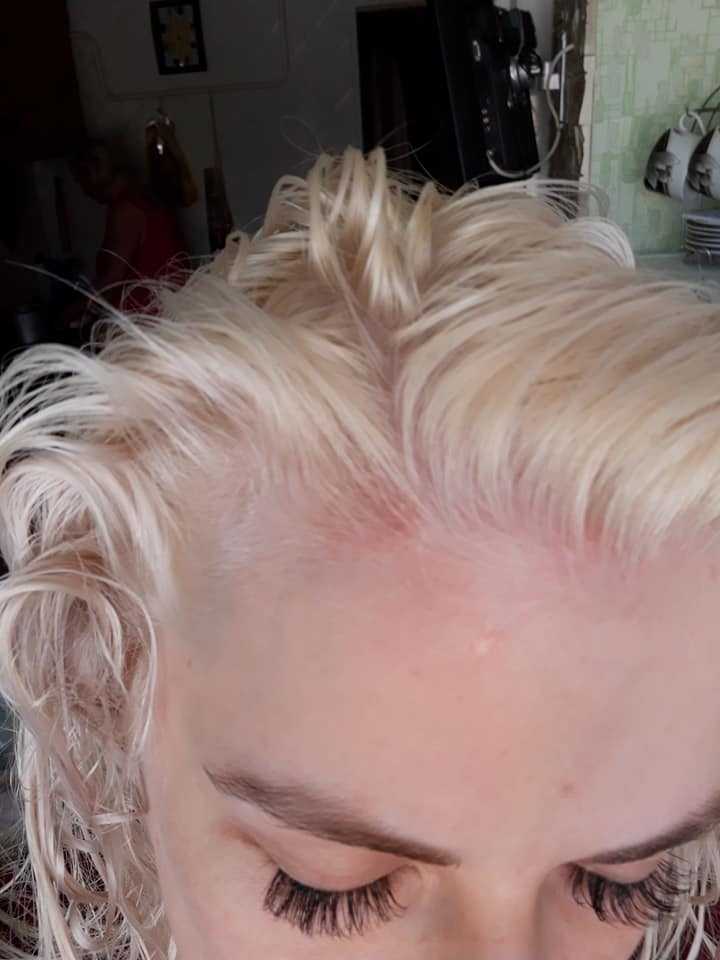 Осветление волос выпали. Ожог головы после окрашивания. Ужасный блонд. Обесцвеченные волосы спаленные.