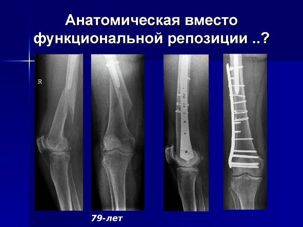 Оскольчатый перелом малоберцовой кости