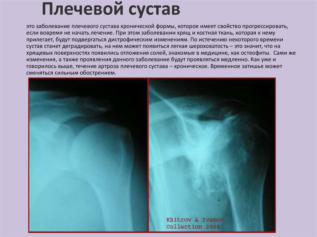 Артроз плечевого сустава 2 степени что это такое и лечение фото