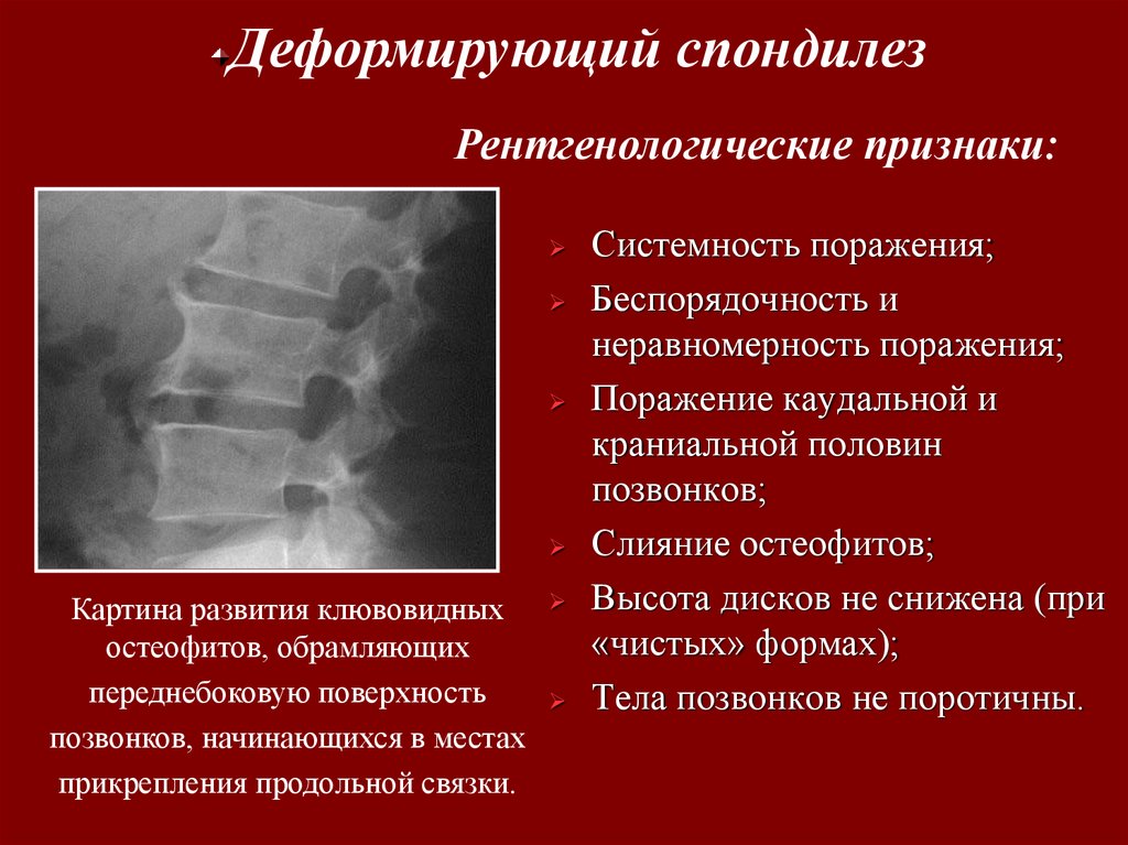 При спондилезе можно. Деформирующий спондилоартроз рентген. Спондилез позвоночника рентген. Остеохондроз стадии рентгенологические. Степени остеохондроза рентген.