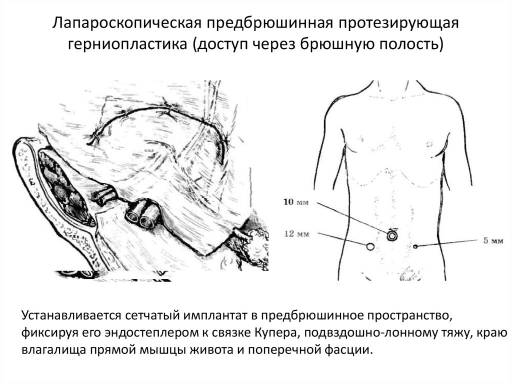 Паховая грыжа без ущемления карта вызова