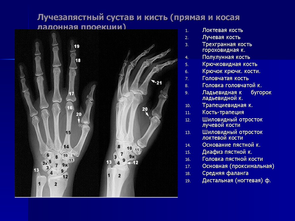 Болезнь кинбека презентация