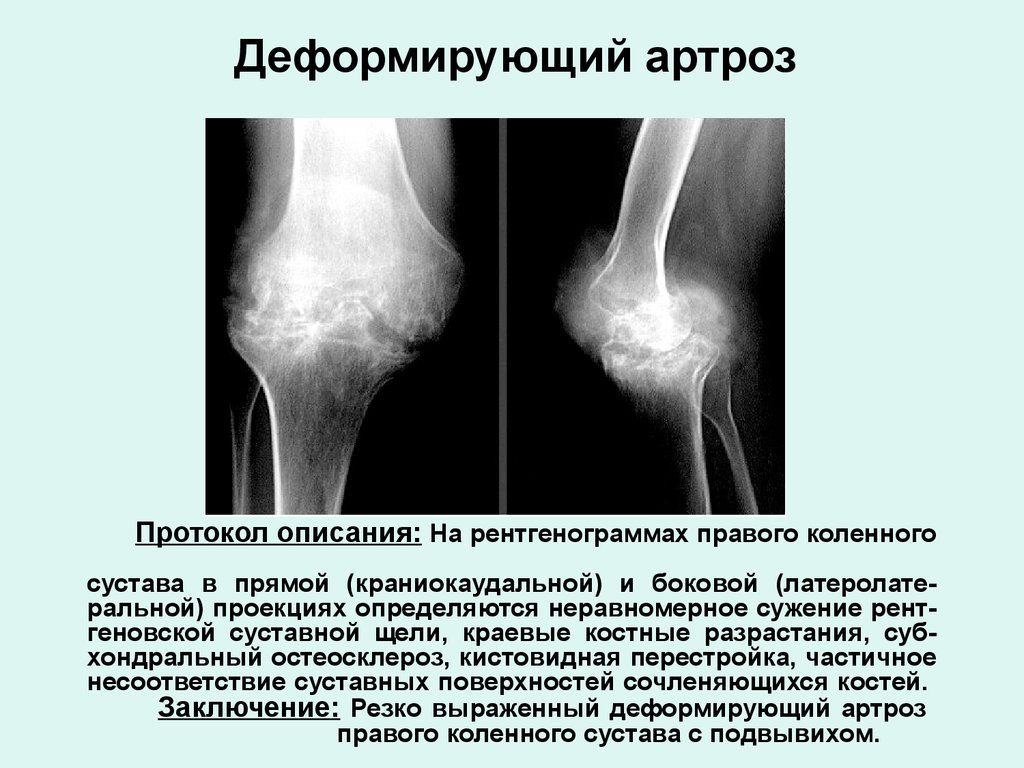 Остеоартроз карта вызова - 86 фото