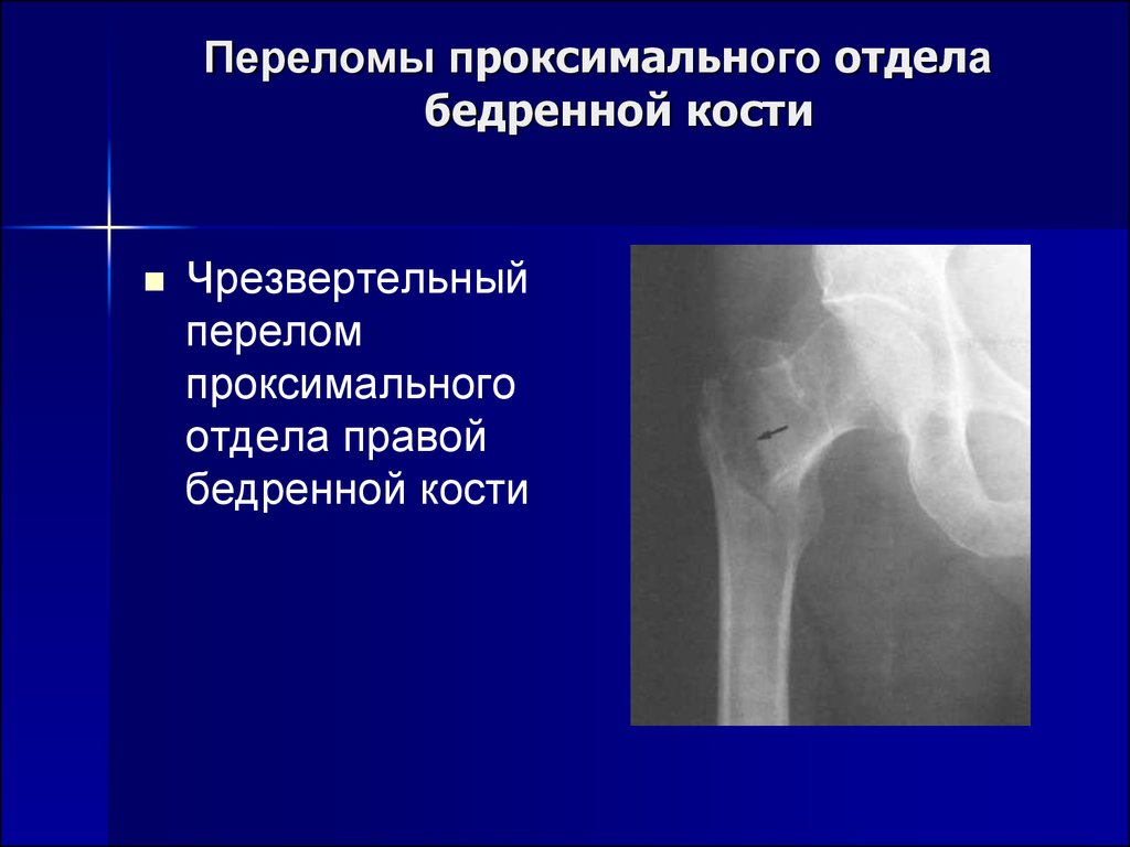 Описание перелома шейки бедра. Переломы проксимального отдела бедренной кости. Перелом шейки бедренной кости рентген. Перелом проксимального отдела бедренной кости рентген. Проксимальный отдел бедренной кости рентген.