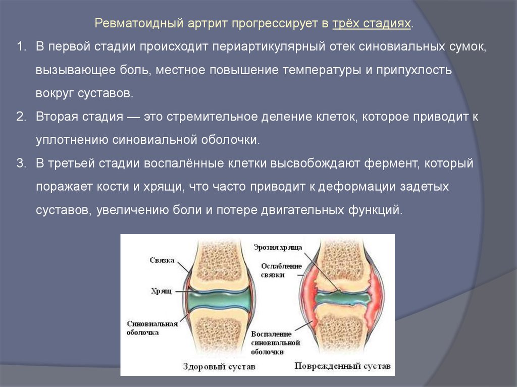 Гонартроз коленного сустава схема лечения