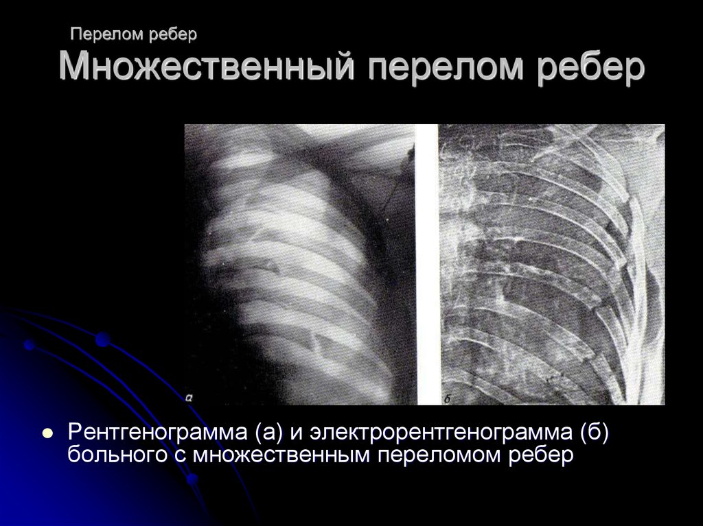 Перелом ребер трещина ребра. Перелом ребер справа рентген. Флотирующий перелом ребер рентген. Множественный перелом ребер пневмоторакс. Консолидированные переломы ребер рентген.