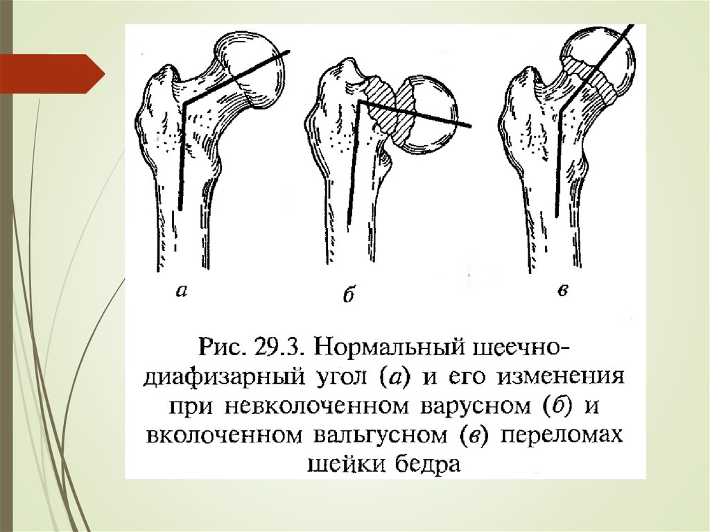 Бедренный угол. Угол шейки бедренной кости. Шеечно-диафизарный угол бедренной кости. Угол шейки бедренной кости норма. Шеечно-диафизарный угол у детей норма.