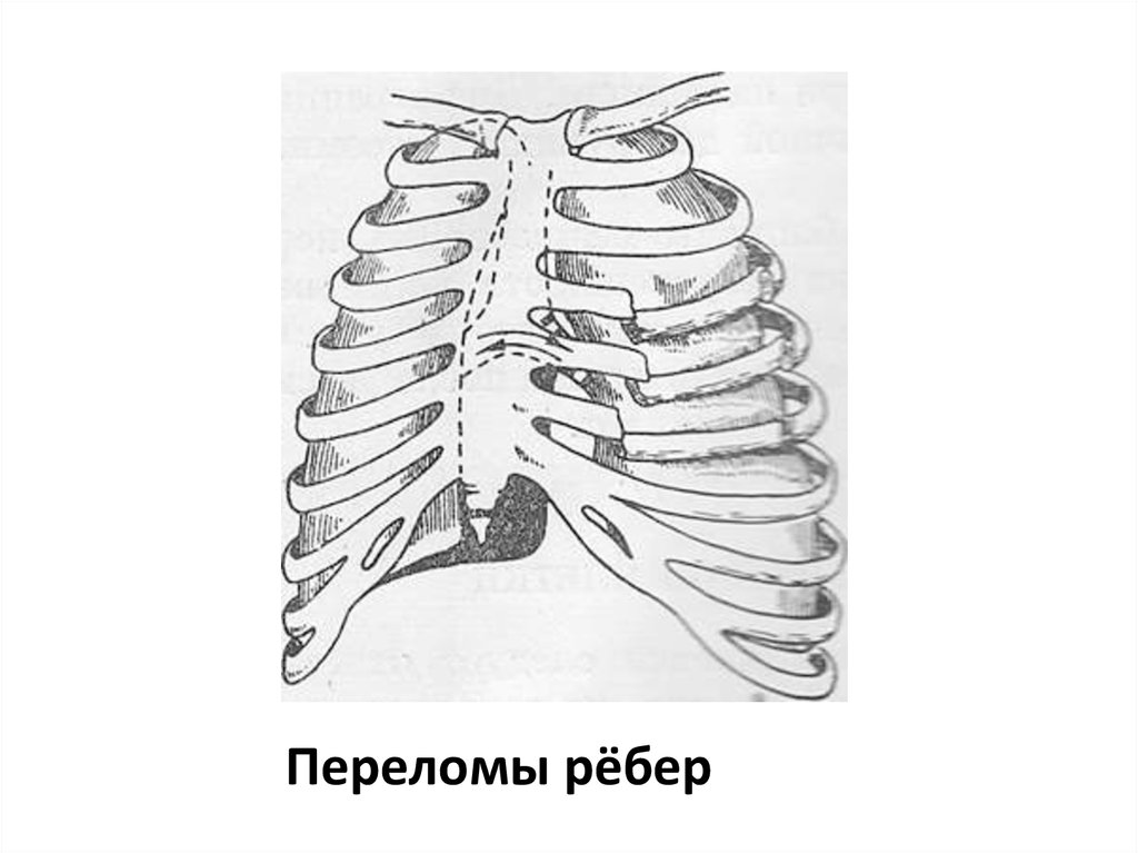 Перелом ребер трещина ребра. Сегментарный перелом ребра. Перелом 4-5 рера.