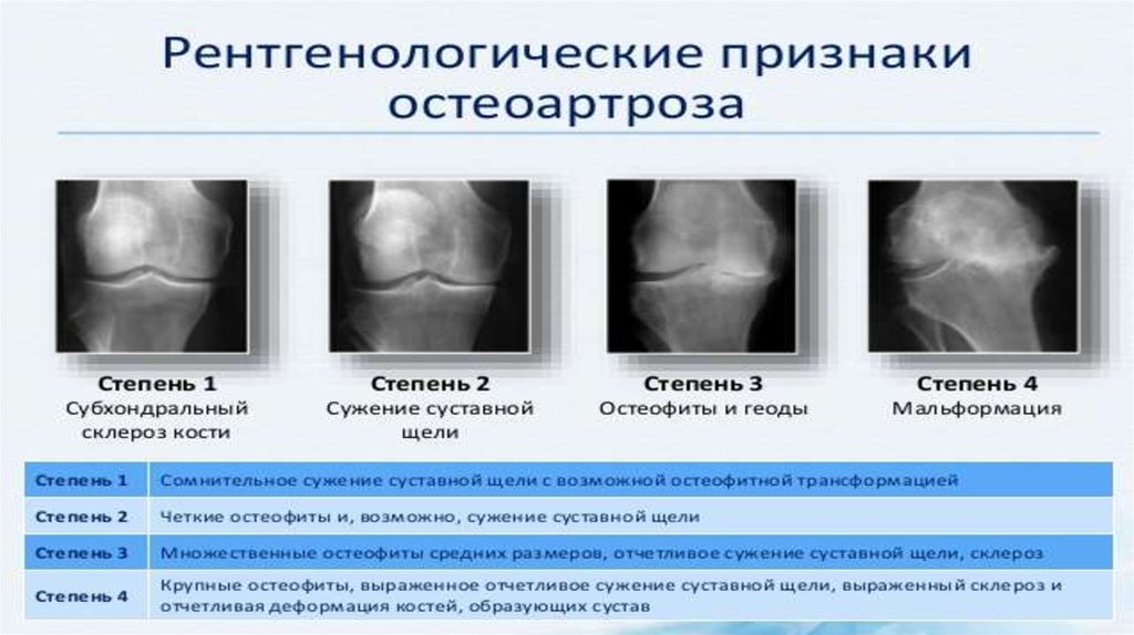 Диагноз доа суставов. Деформирующий остеоартроз рентгенологические стадии. Остеоартроз стадии рентген. Степени остеоартроза коленного сустава рентген. Деформирующий остеоартроз степени.