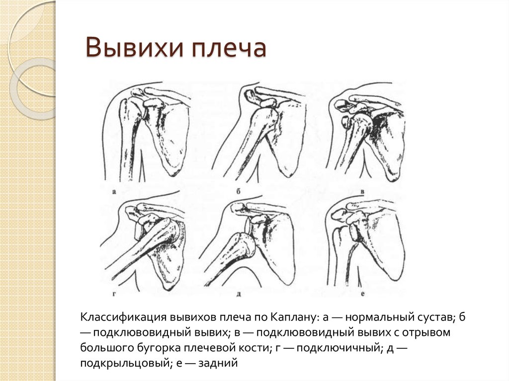 Вывих плечевого сустава карта вызова скорой