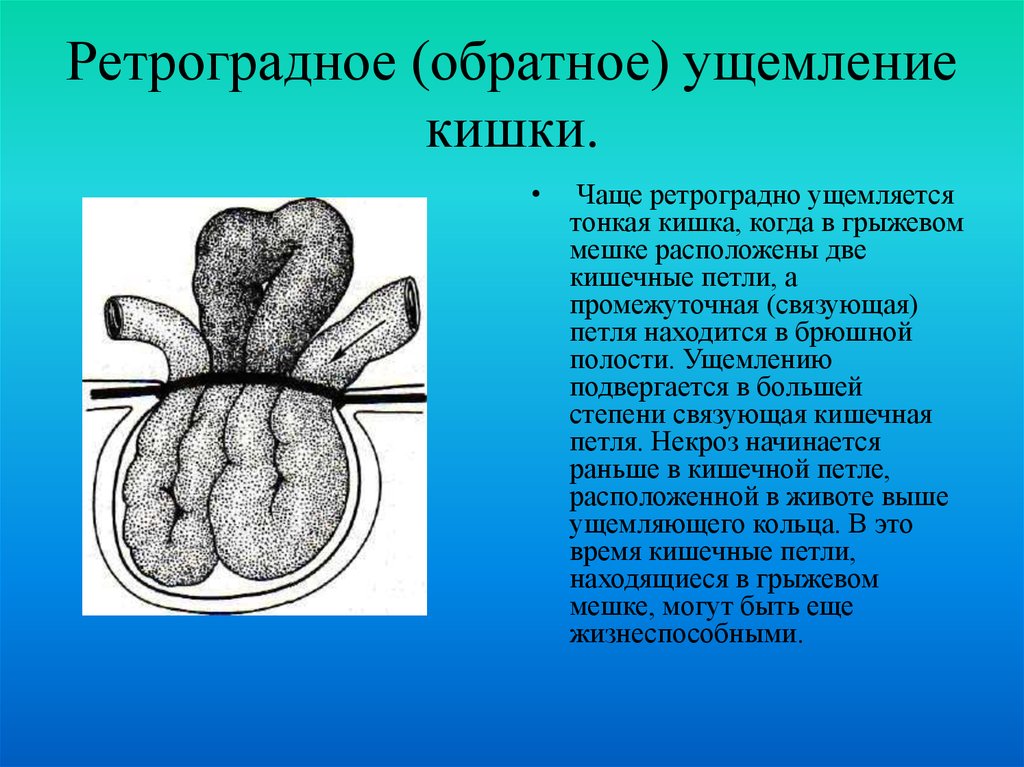 Вентральные грыжи презентация