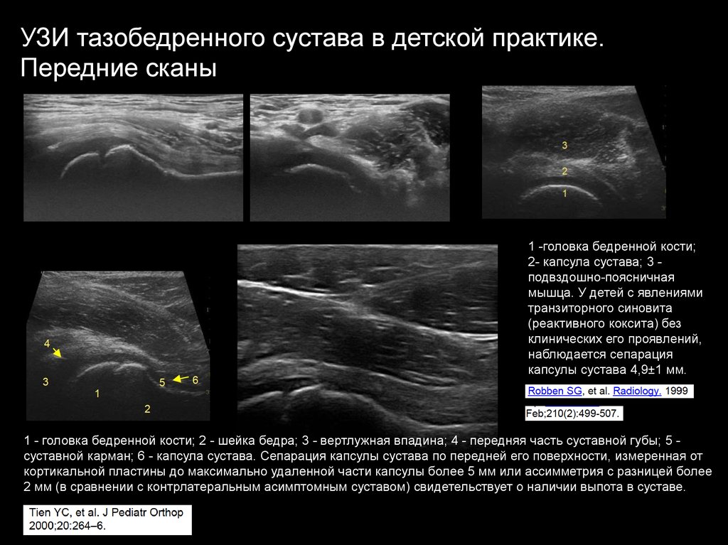 Что покажет узи тазобедренного сустава. Шеечно-капсулярное пространство тазобедренного сустава УЗИ. УЗИ тазобедренных суставов, методика, протоколы, УЗИ анатомия. УЗИ тазобедренного сустава заключение. УЗИ тазобедренного сустава протокол УЗИ.