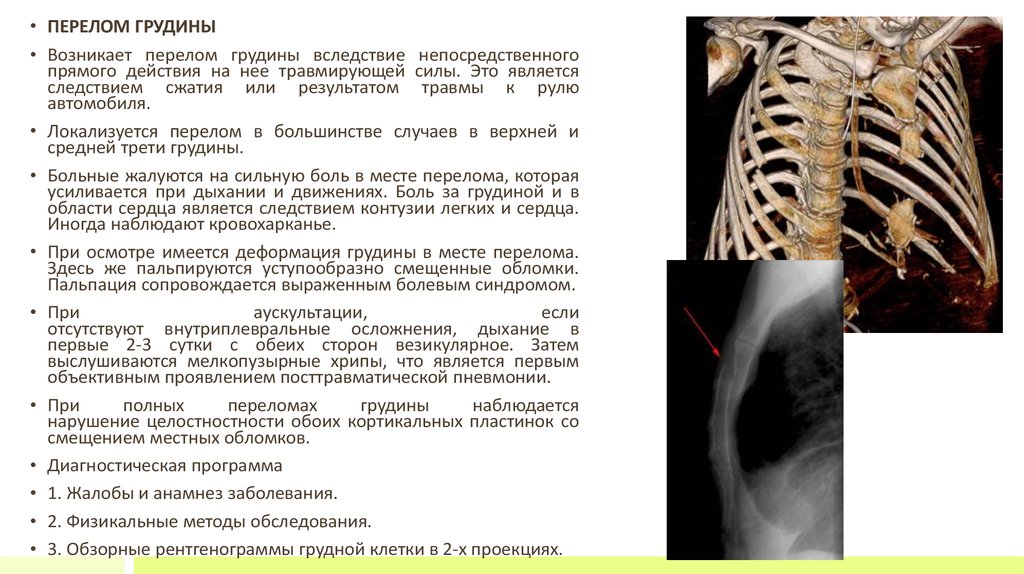 Перелом ребра симптомы и лечение