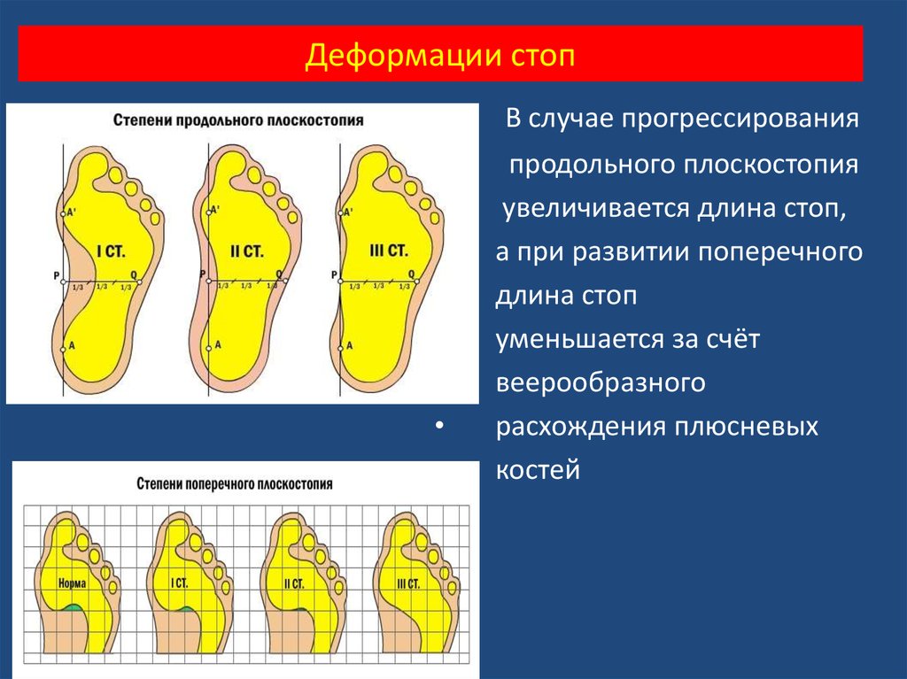 Москва деформация стопы. Степени плоскостопия вид сбоку. Продольное плоскостопие косолапость. Поперечное плоскостопие и вальгусная деформация. Продольное плоскостопие деформация стопы.