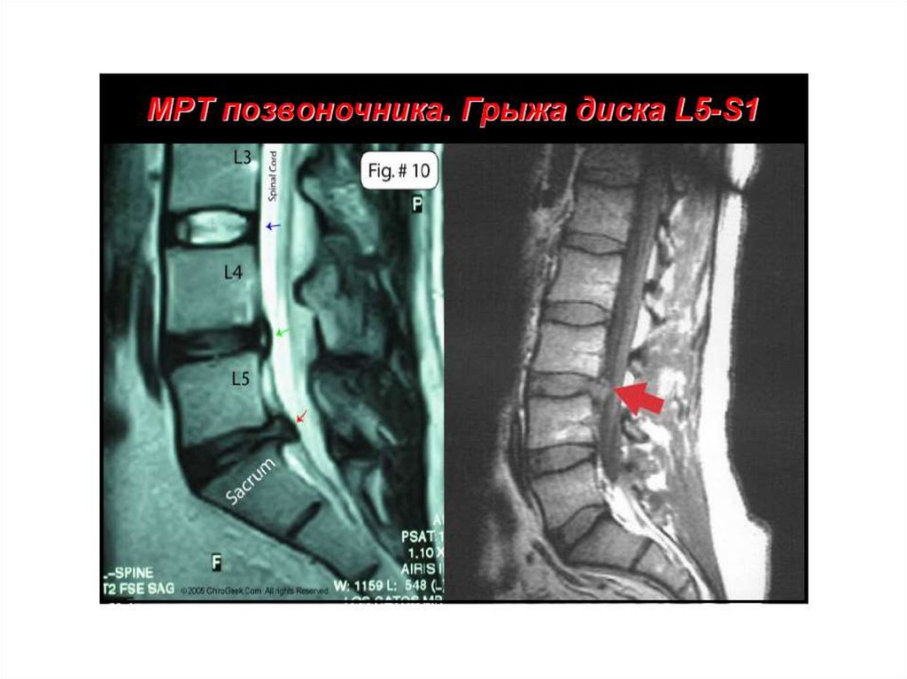 Как выглядит грыжа на позвоночнике в поясничном отделе фото
