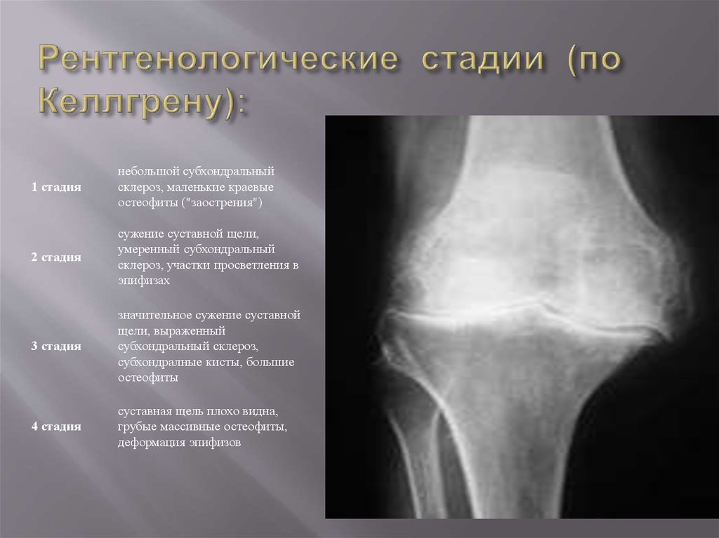 Остеофиты вертлужной впадины