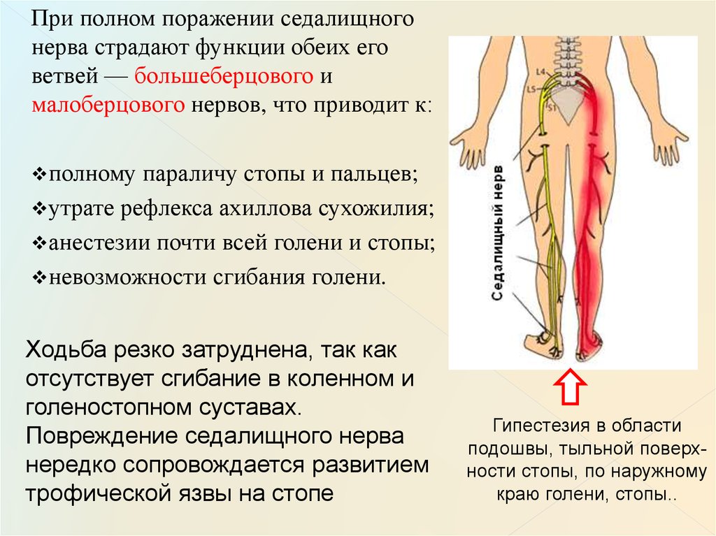 Большеберцовая нейропатия. ЛФК нейропатия седалищного нерва. При защемлении седалищного нерва болит нога. Седалищный нерв симптомы.