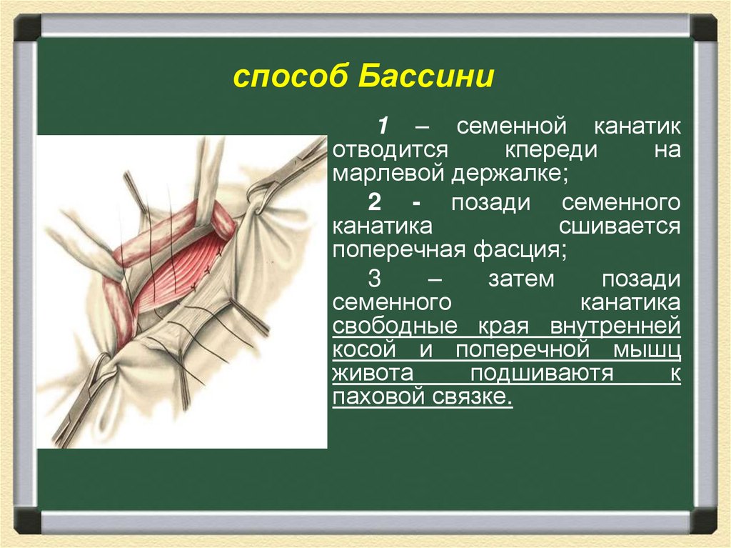 Грыжа казакша презентация