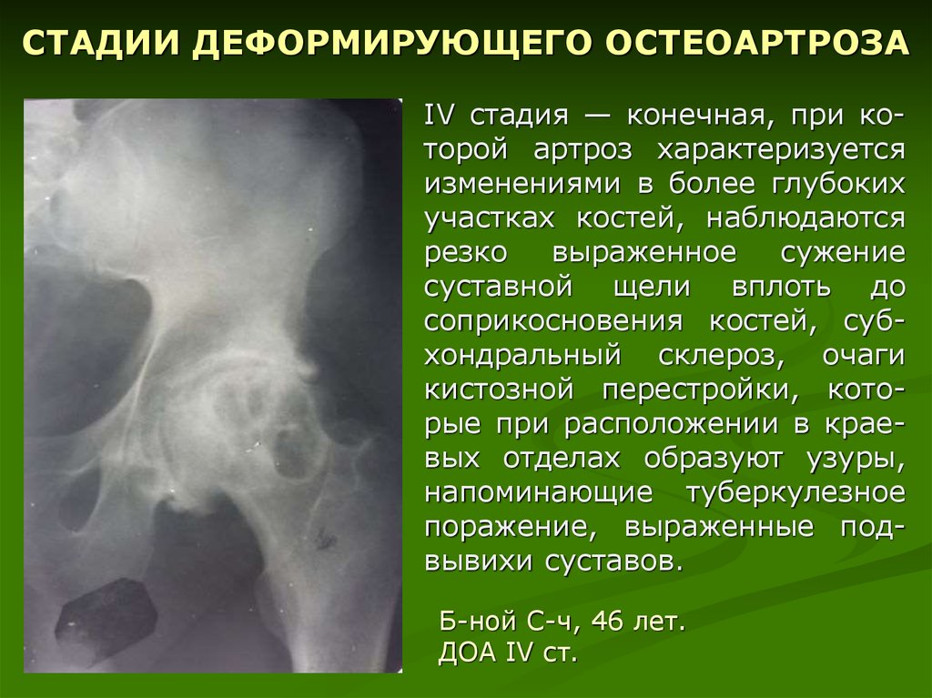Коксартроз презентация травматология