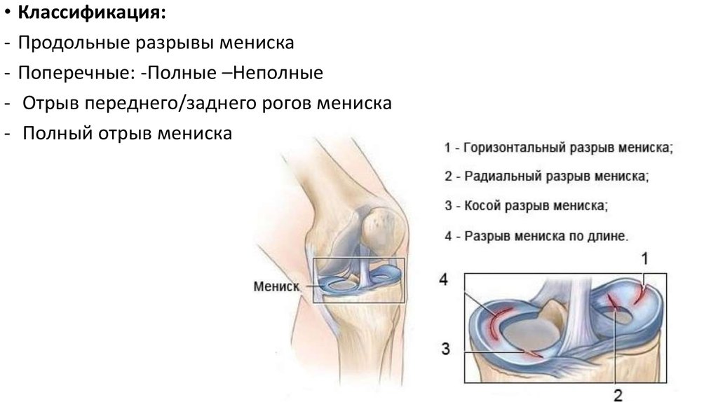 Изменения медиального мениска 1 степени. Разрыв мениска коленного сустава на УЗИ. Задний мениск коленного сустава повреждение. Коленный сустав строение мениск. Мениск коленной чашечки разрыв.