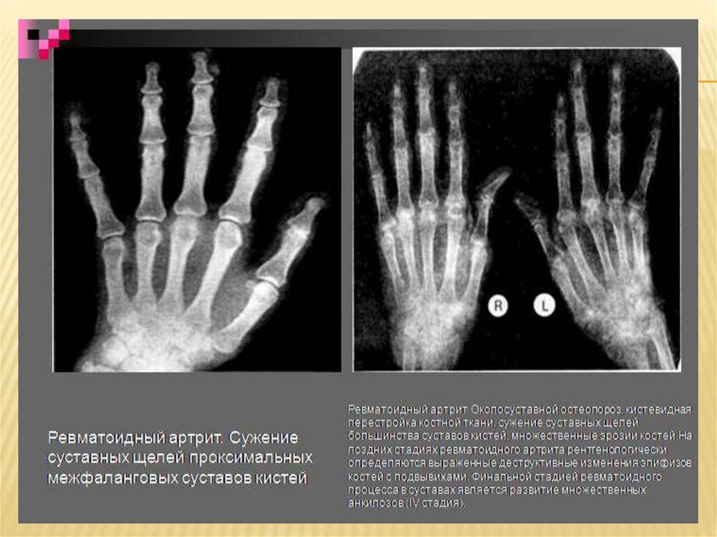 Остеопороз кистей рук фото