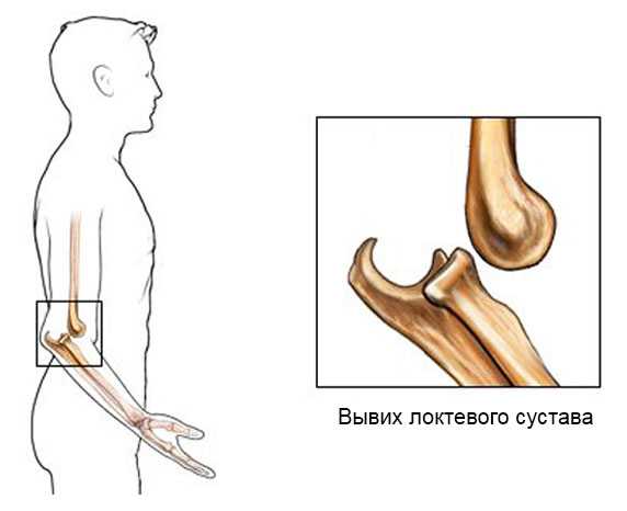 Вывих локтевого сустава у детей карта вызова скорой