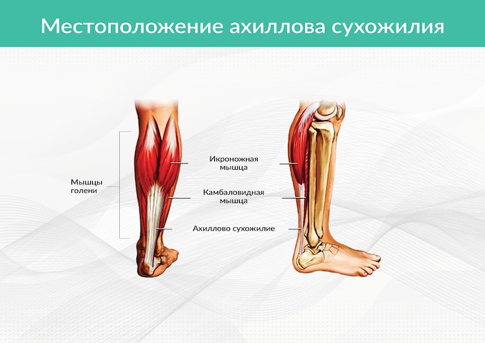 Где находится ахиллово сухожилие на ноге фото у человека как лечить