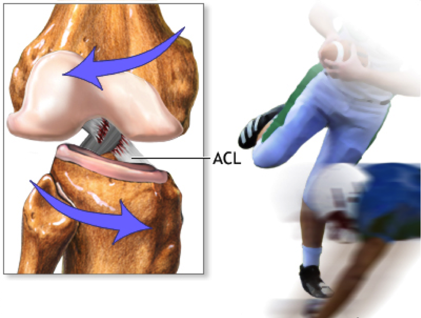 Разрыв крестообразной связки. Повреждение передней крестообразной связки колена. Разрыв крестообразной связки колена. Разрыв передней крестообразной связки (ACL.