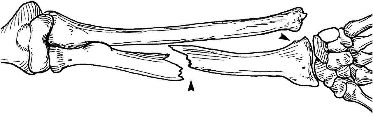 Рисунок сломанной кости