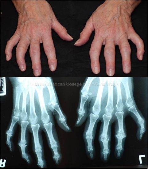 Ревматоидный артрит на руках фото