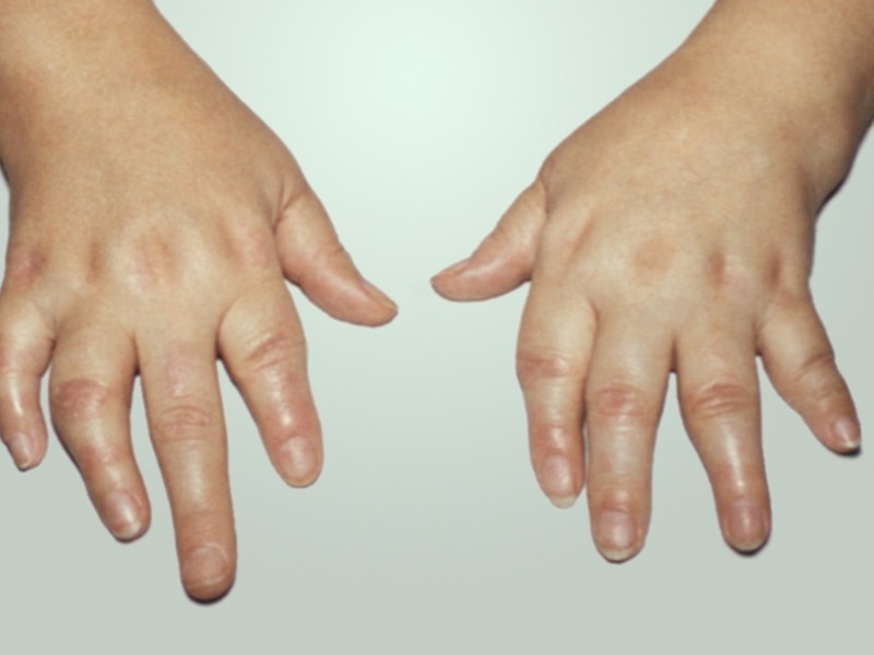 Ревматоидный артрит кистей рук фото