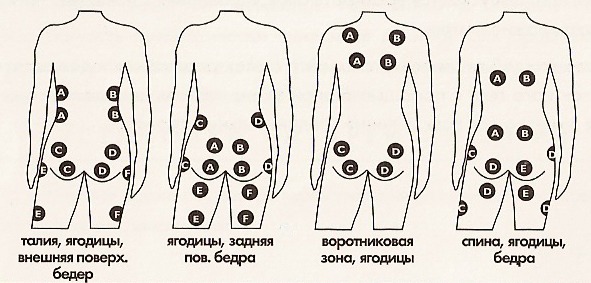 Схема вакуумных банок на спине