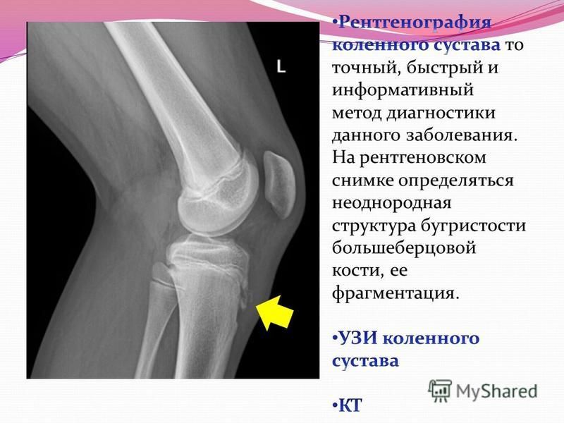 Изображение коленного сустава рентгеновское