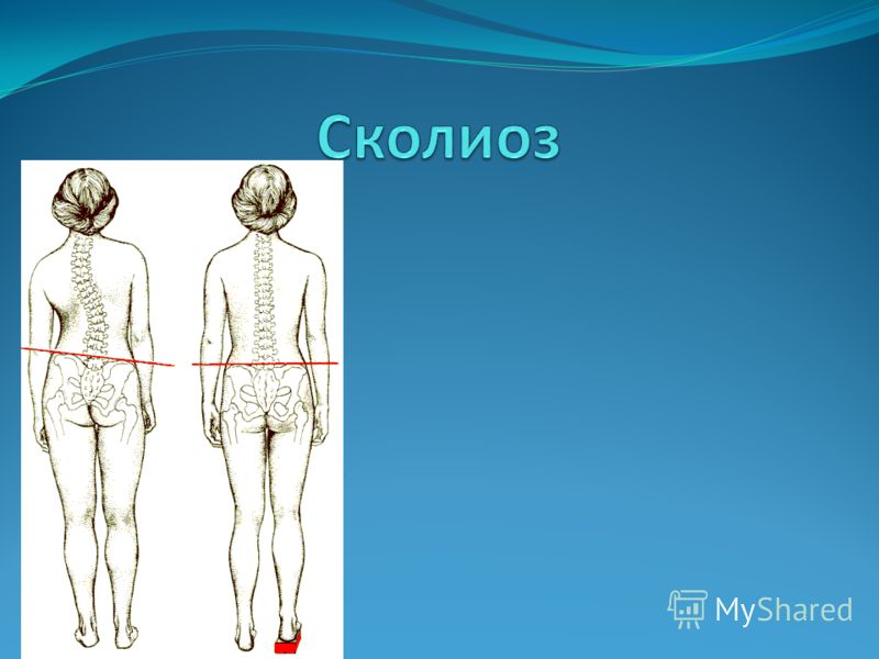 Боковое искривление позвоночника называется