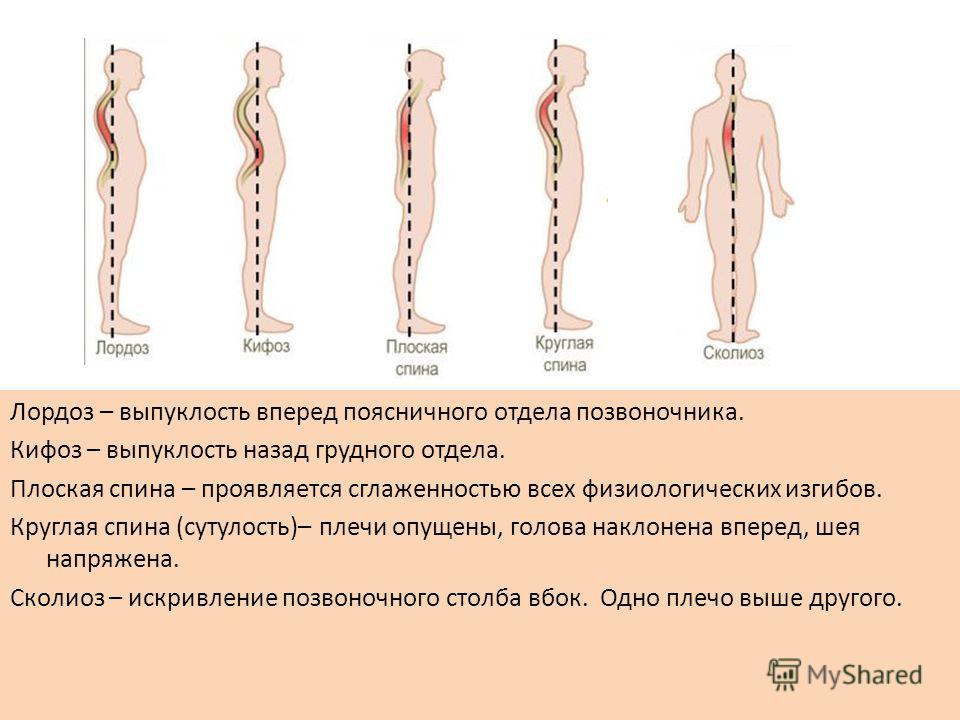 Лордоз и кифоз фото