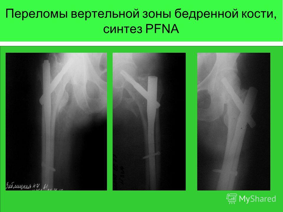 Переломы бедра презентация