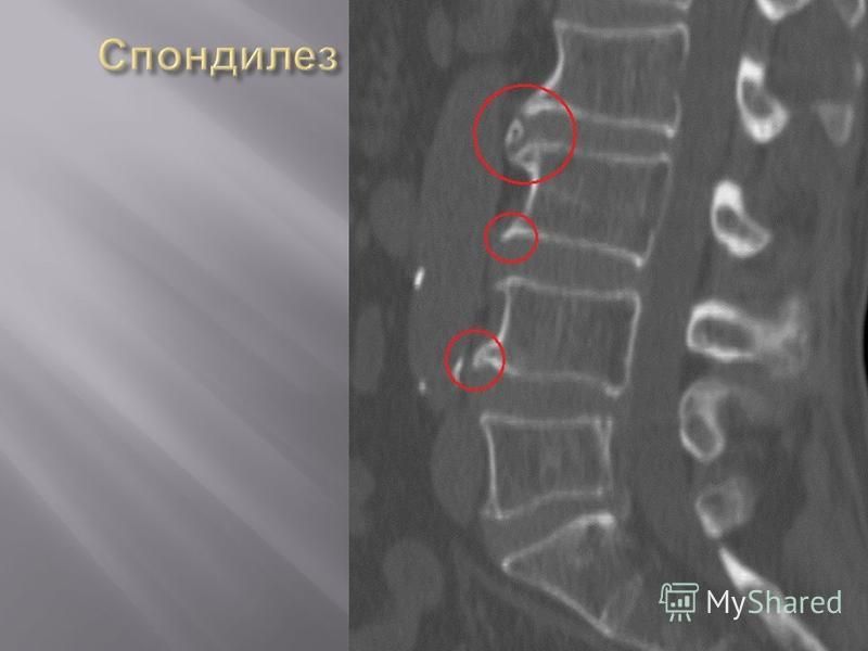Спондилез это простыми. Спондилез шейного отдела рентген. Спондилёз пояснично-крестцового отдела l1 l2. Спондилёз шейного отдела позвоночника рентген. Остеофиты на рентгене позвоночника.