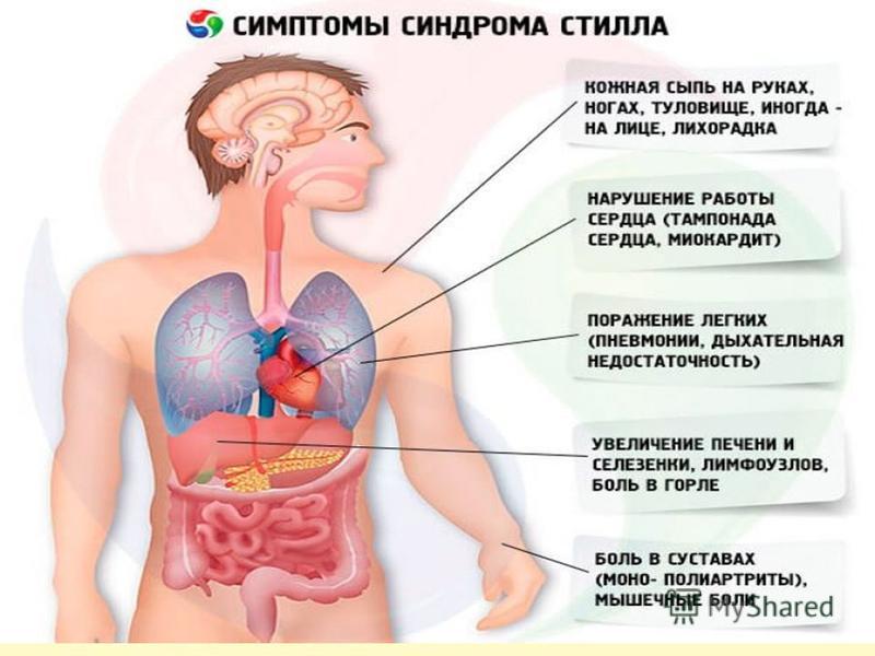 Презентация болезнь стилла