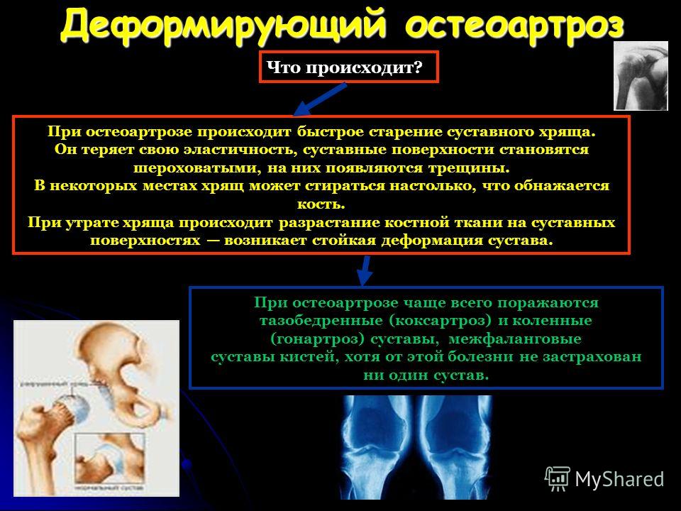 Деформирующий остеоартроз мкб 10