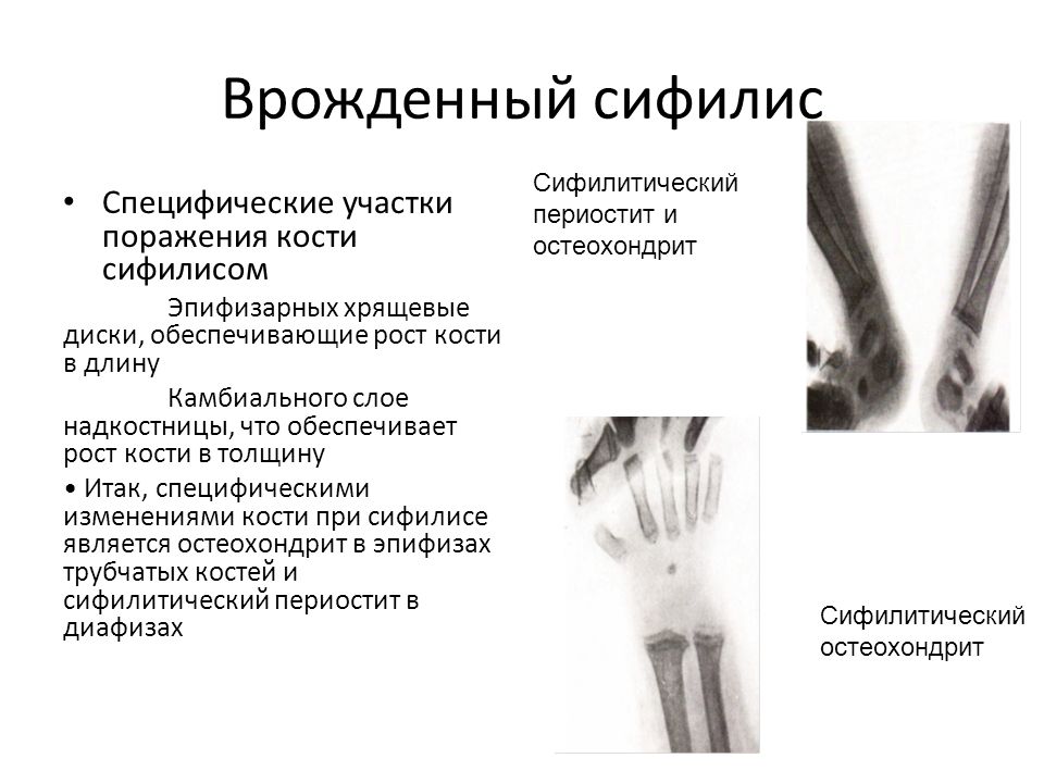 Изменения в костях