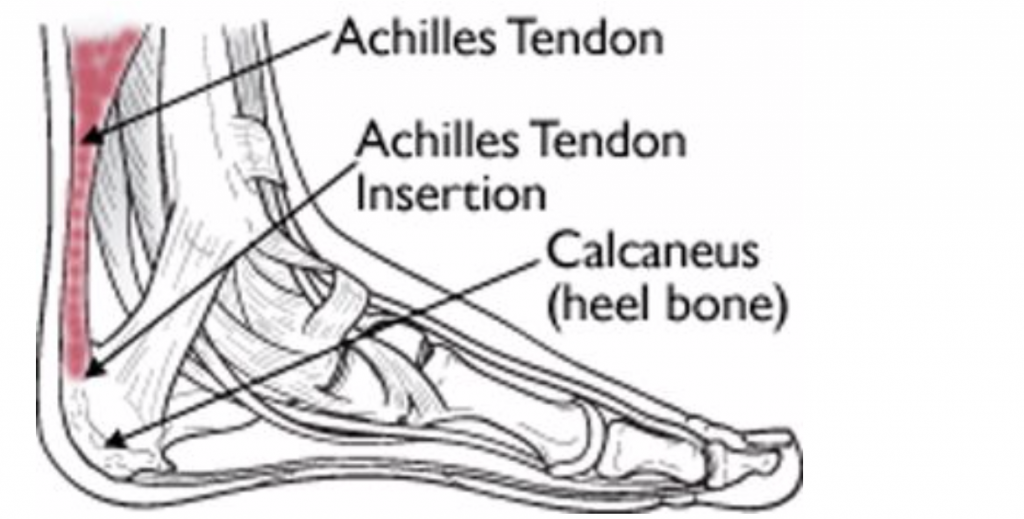 Почему болят сухожилия пятки. Тендинит ахиллового сухожилия. Тендиноз сухожилия пяточной кости. Тендинит сухожилия большеберцовой мышцы. Распухло ахиллово сухожилие.