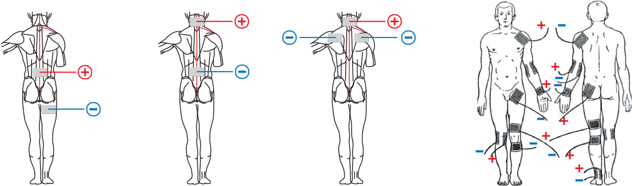 Правильная терапия. Электрофорез схемы наложения электродов. Электростимуляция схема наложения электродов. Электростимуляция мышц схема наложения электродов. Схема расположения электродов для электрофореза карипазимом.