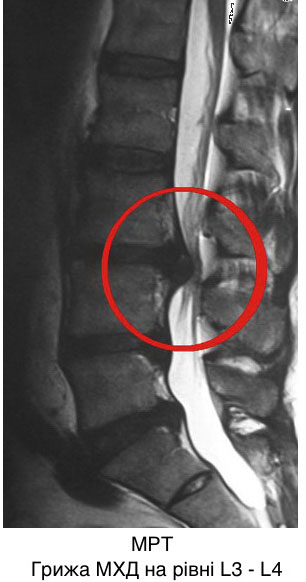 Грыжа на мрт позвоночника фото