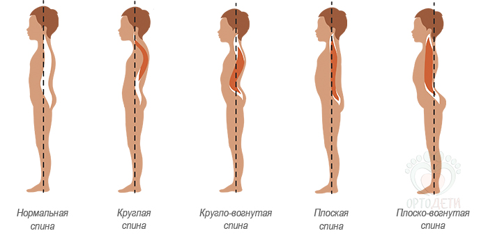 Все виды искривления позвоночника с картинками