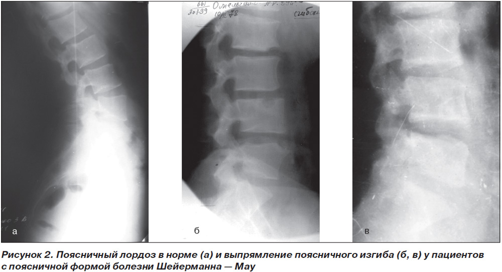 Сглаженность поясничного лордоза фото