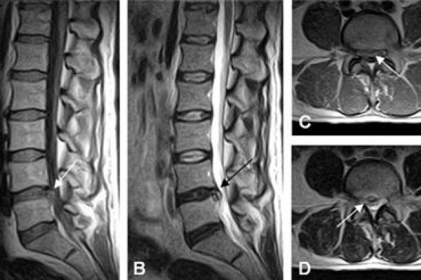 Как на мрт выглядит грыжа позвоночника фото